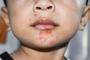 10歲孩嘴唇腫脹　組織液不斷流出是「這病」！接觸傳染　照護者要小心