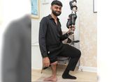 男患骨癌醫將截肢右腳「反轉接上」　3年後他終於能走了！