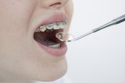 矯正期間蛀牙怎麼辦？牙醫：應更注重口腔衛生　嚴重需將矯正器拆掉