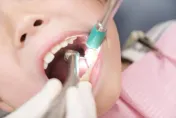 矯正牙齒不只防牙亂！戽斗更需要防　醫師：孩子8歲就該開始觀察門牙