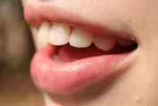 缺牙怎麼辦？傳統牙橋和植牙的差異？專業牙醫一次解析！