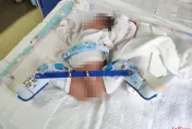男嬰出生2天狂哭不止…送醫才知大腿骨折　家長怒控遭剖腹產醫師用力過猛掰斷