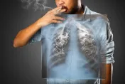 老菸槍兩度「氣胸」嚇壞決心戒菸！　醫：吸菸易致肺部長氣泡破裂