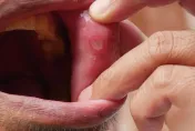 常嘴破4成是１疾病患者！抽血檢驗就可以得知