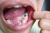 衛福部統計6歲童蛀牙率近8成！北市聯醫5大院區提供「6～12歲免費塗氟」