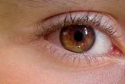 遺傳、年紀大「眼袋」越來越明顯？做對4件事有效預防眼袋形成
