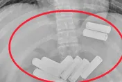 23歲男子吞「11顆3號電池」險腸穿孔！醫花1小時才取出