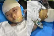 影/腦漿都出來了！9歲女童遭男師打碎頭骨　開顱手術5小時仍在危險期