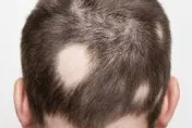 「圓禿」讓青少年失去自信「恐導致拒學」　醫師：確認落髮原因…藥物可治療
