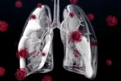 肺癌發生率竄升榜首！該選哪種手術？　醫揭「關鍵選擇考量」