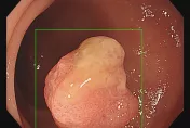 大腸裡滿滿瘜肉！醫揪1.2公分早期大腸癌瘜肉　外觀有菱角、周圍明顯雞皮