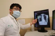 6旬婦「免疫力差狂喘咳」　X光照出「肺部開一個洞」隱球菌症上身