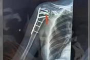 女子3年前手臂骨折植入鋼板　回診照X光卻發現「手術鑽頭遺留在內」