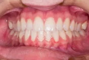 不能都怪火氣大！盤點「牙齦腫脹」原因　醫：多是口腔健康影響