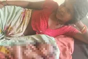 影/罕見！印度女子生下「2張臉4隻手臂」嬰兒　僅存活5小時就夭折