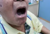 嚼越久危害越大！90歲阿公嘴破拖1年…唇下「掛3公分腫瘤」二度罹癌