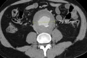 腰痛、背痛以為腎結石復發！醫揪近8cm巨大「腹主動脈瘤」