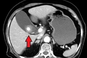 43歲婦上腹痛、噁心竟是「膽結石」惹禍！醫揭：女性機率是男性2倍