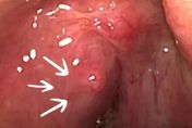 他喉嚨痛3天「扁桃腺周圍膿瘍」壓迫呼吸道只剩一半