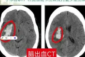 嚇！陸男坐雲霄飛車竟「顱內出血」　醫：太刺激非人人適合
