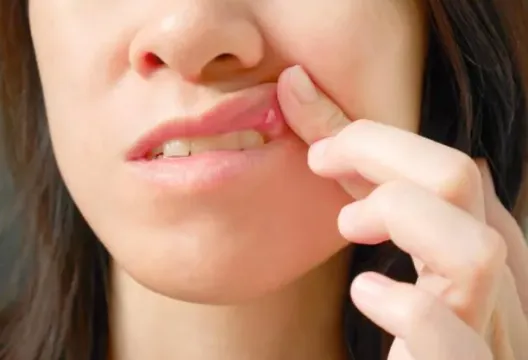 嘴破超過2週恐罹癌！醫揭「破、斑、硬」都是前兆