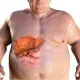 以為吃得健康！中年女重度脂肪肝+高血糖　營養師一看飲食：滿滿地雷
