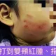 阿嬤跟妳拚了！桃園幼幼班女童午休發出聲響　教保員竟狂搧巴掌「留紅指印」