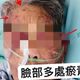 影/台中嬤莫名「瘀青」滿身傷　家屬驚見看護揮打氣炸