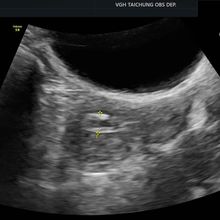 停經多年突然出血？婦以為「回春」檢查竟是子宮內膜癌