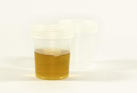 尿液呈「紅茶色、烏龍茶色」肝臟求救警訊　嚴重恐致死