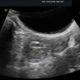 停經多年突然出血？婦以為「回春」檢查竟是子宮內膜癌