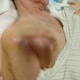 觸目驚心！94歲長者疑在護理之家遭虐　右半身瘀青發黑