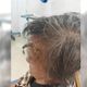 98歲阿嬤「額頭長角」！自剪大出血險喪命
