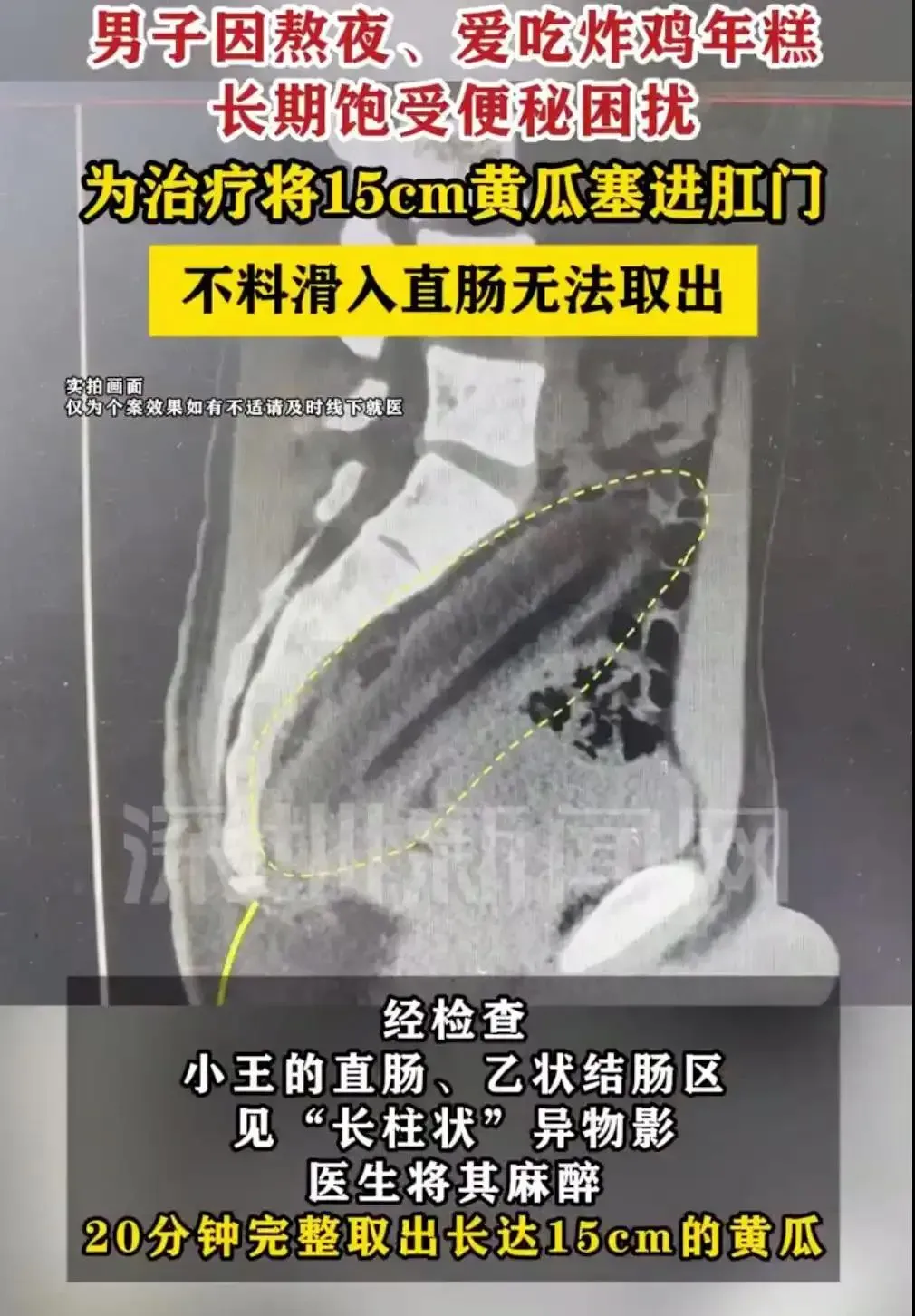 男子誤信偏方治便祕將15公分的黃瓜塞入體內。（圖／翻攝微博）
