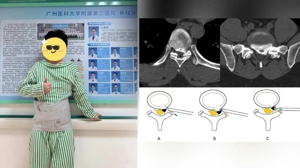 廣州30歲男子突然下身癱瘓。（圖／翻攝自廣醫二院）