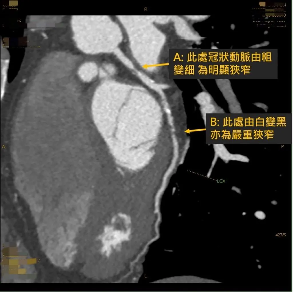 1024切冠狀動脈電腦斷層顯示,林先生的血管多處嚴重狹窄。(圖/安南醫院)