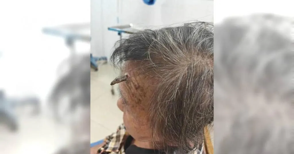 98歲的顧姓老婦額頭上長出「角」，相當嚇人。（圖／翻攝自環球網）