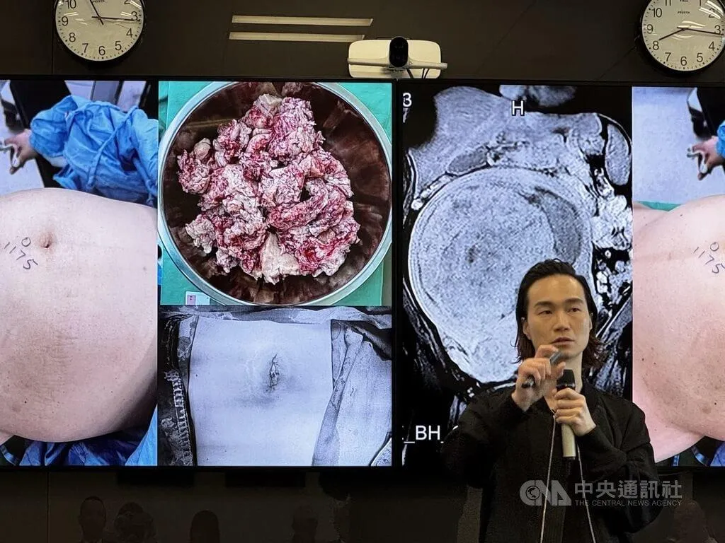 子宮肌瘤是女性骨盆腔常見腫瘤，新光醫院婦科機械手臂暨微創中心主任李偉浩15日在衛教記者會中，分享使用單孔機器手臂治療案例。（文／中央社）