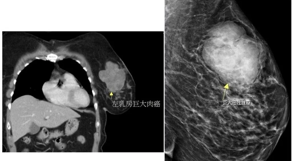 苗栗有婦人單側乳房出現硬塊,就醫檢查出近10公分大腫瘤,是發生率低且罕見出現在乳房部位的肉癌。(圖/大千綜合醫院)