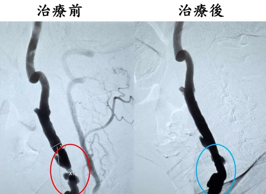 一名65歲魏姓男子因頭暈不適就醫,檢查後發現右側頸動脈嚴重狹窄且大腦已有陳舊性中風跡象。(圖/大千綜合醫院提供)