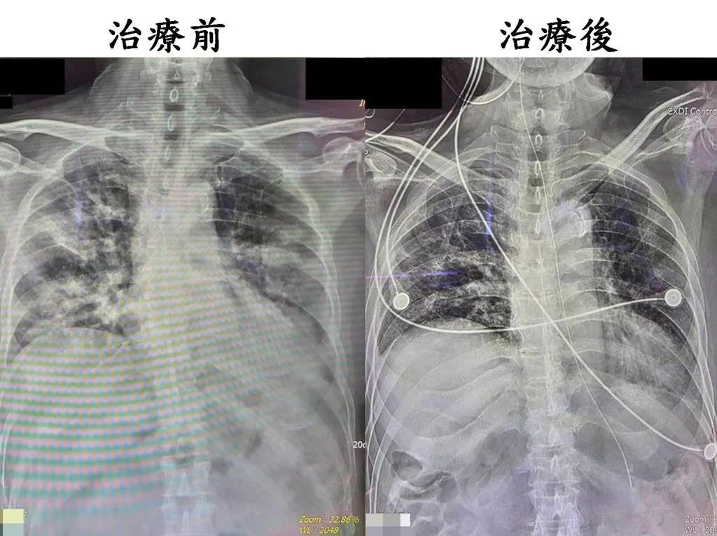 劉先生送醫後,X光及電腦斷層檢查發現,他的雙側肺部嚴重浸潤發炎,呈現發白狀態,無法進行正常氣體交換。(圖/大千醫院提供)