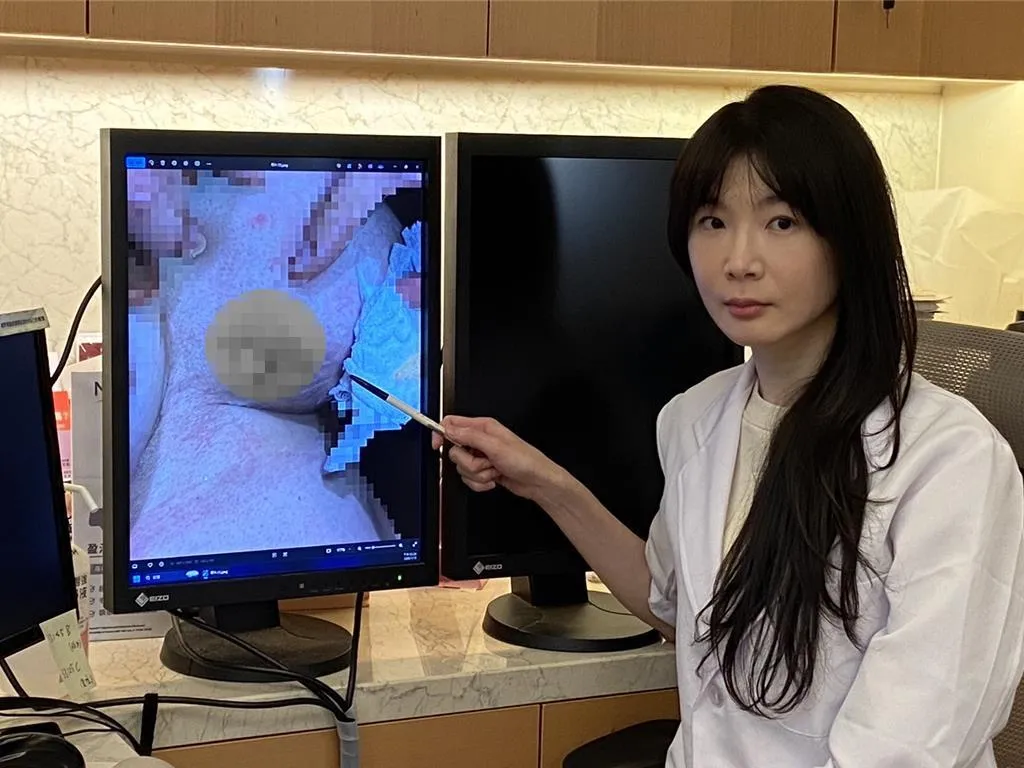 女子將握式暖暖包夾在乳溝內禦寒，未料9小時後取出才驚覺左乳皮膚已紅腫脫落並流出黃色組織液。（圖/茂盛醫院）