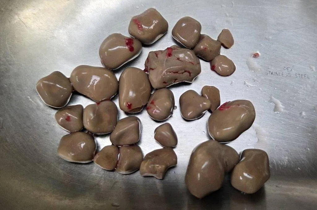 老翁透過X光檢查發現膀胱內一堆大小結石,經手術後共取出24顆光滑如鵝卵石的結石。(圖/黃才倍提供)