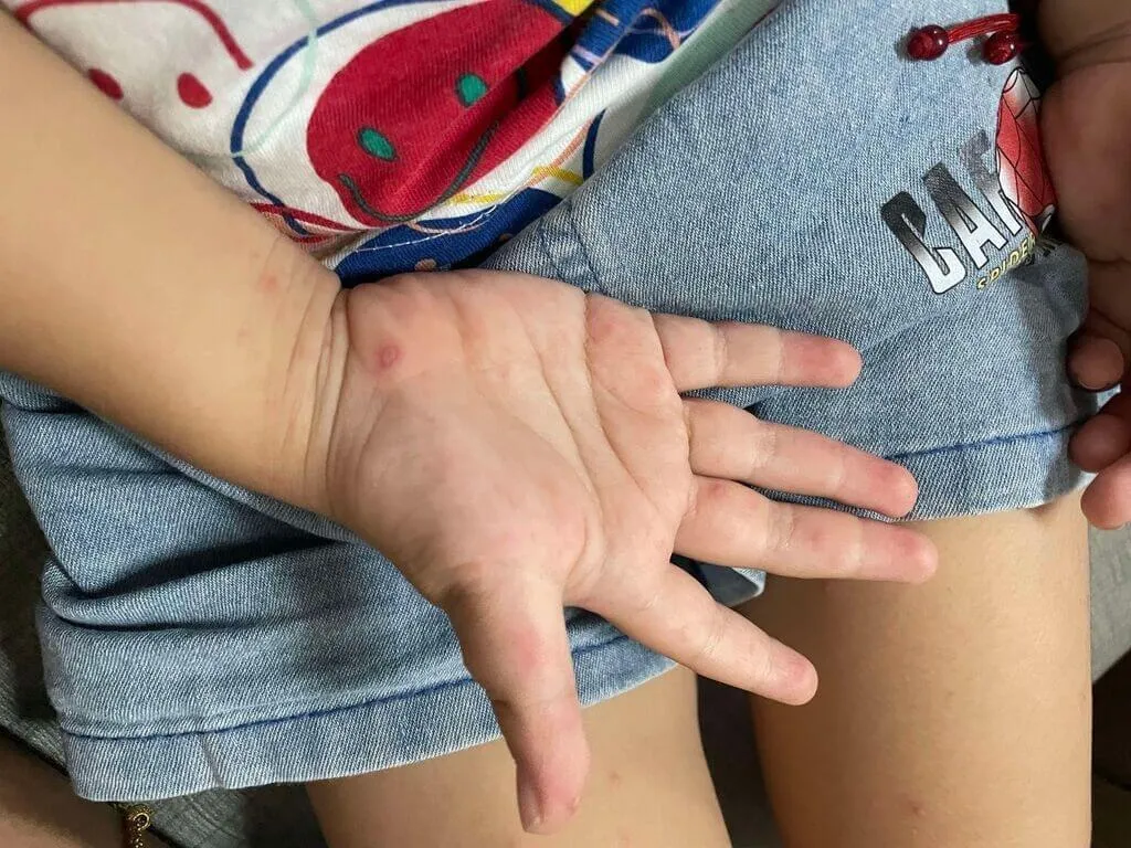 5歲以下兒童都是腸病毒高危險群,尤其接下來4到6月進入流行期,若家中孩童有出現症狀,都要盡速就醫。(圖/報系資料照)