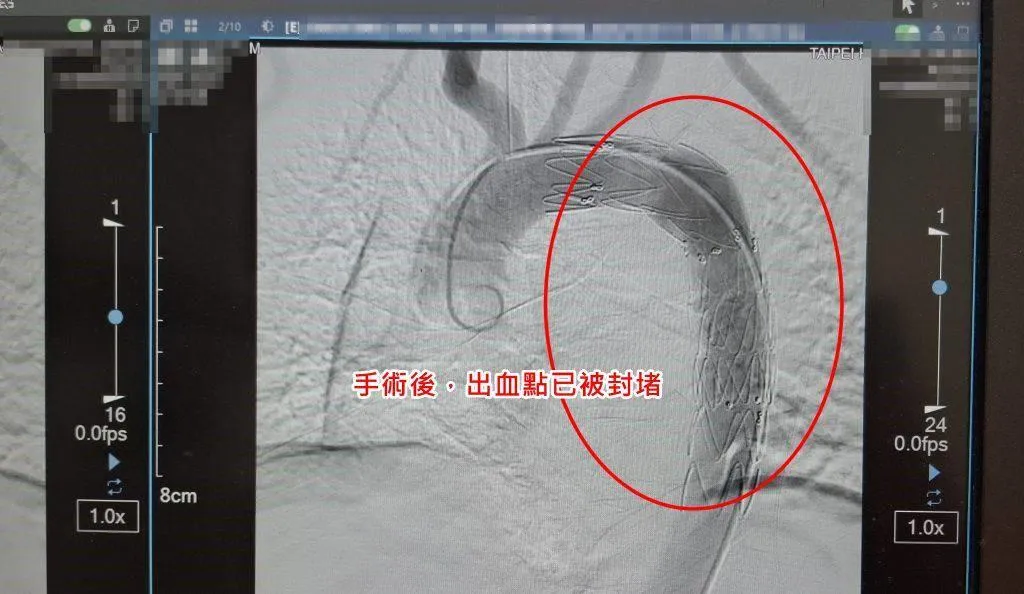 醫療團隊採取「胸主動脈支架置放手術」，以不到1公分的微小傷口成功化解大出血危機，廖先生術後恢復良好，現已平安出院。（圖／部立台北醫院提供）