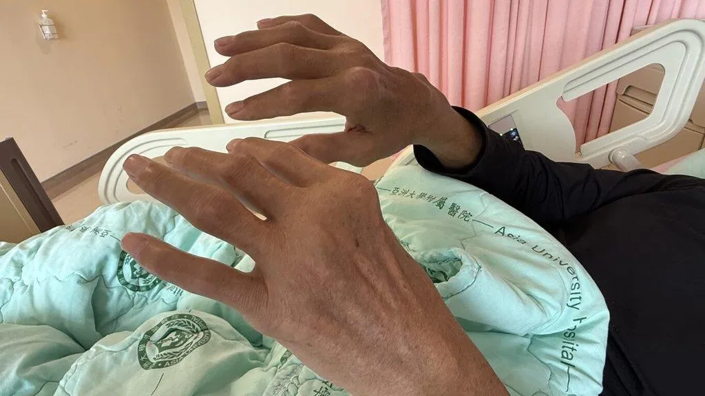 台中黃姓男子長年患有痛風未控制，因長時間尿酸失控下，尿酸結晶不斷沉積於關節與周邊軟組織，逐漸形成一顆顆肉眼可見的痛風石，明顯分布於手指、手腕等處。（圖／亞大醫院）