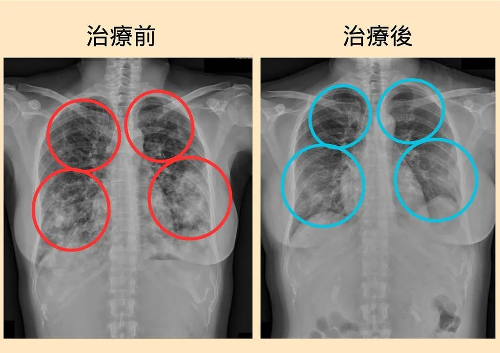病人經檢查發現雙側肺部有廣泛性浸潤（紅圈處），經治療後順利改善（藍圈處）。（圖/大千醫院提供)