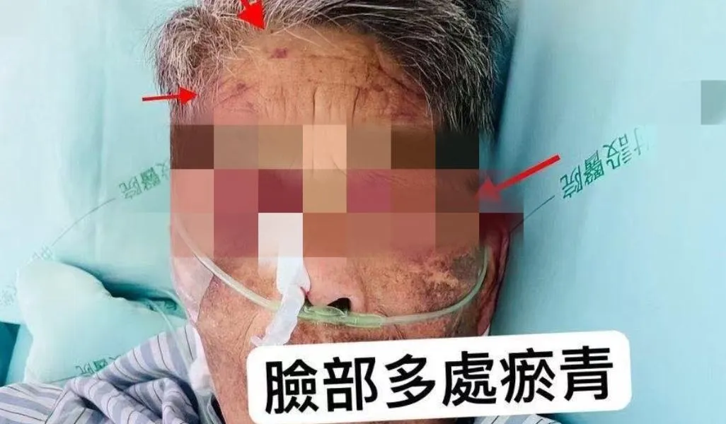 阿嬤臉部多處瘀青。（圖／中天新聞）