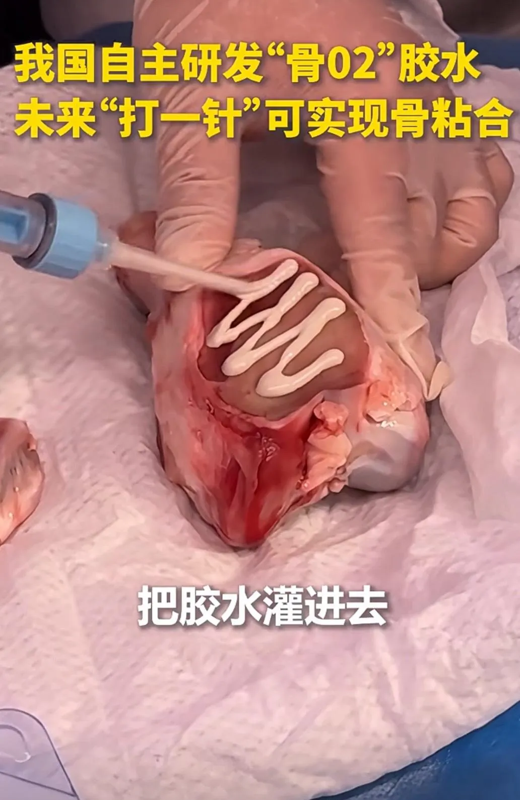 大陸研發全球首「骨膠水」，黏合骨頭僅需3至5分鐘。（圖／翻攝《人民日報》）