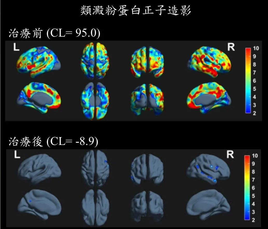 類澱粉蛋白正子造影檢查顯示，治療前（上圖）腦中異常蛋白負荷顯著增加，治療六個月後（下）降至正常範圍。（圖／土城長庚醫院）